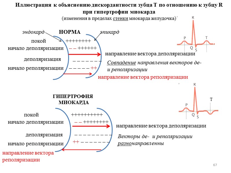 67 Иллюстрация к объяснению дискордантности зубца Т по отношению к зубцу R при гипертрофии 67 Иллюстрация к объяснению дискордантности зубца Т по отношению к зубцу R при гипертрофии